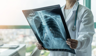 肺腺癌研究重大突破！中研院揭示關鍵機轉、治療新契機