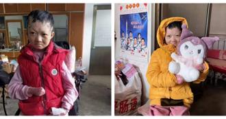 皮膚脆如蝶翼！一生與病魔相伴「蝴蝶寶寶」逝世  弟弟同樣受折磨