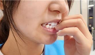 導致甲溝炎常見3大危險習慣 醫提醒：指甲別修「U字型」