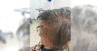 98歲阿婆「額頭長角」自己剪掉險大出血命危 醫嚇：差點來不及