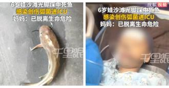 海洋無聲殺手！6歲童沙灘赤腳踩死魚感染創傷弧菌險截肢