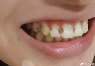 妹子戴牙套5年坏了8颗牙「牙缝都是洞」！医听她洁牙方法直摇头