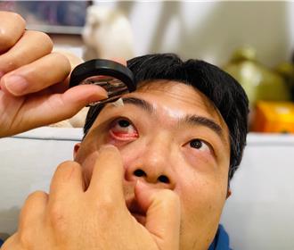 長針眼是看到不該看？藥師破解迷思 曝日常護理5妙招