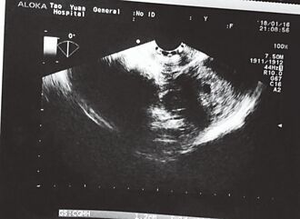 桃園高風險孕產婦關懷 將提升量能