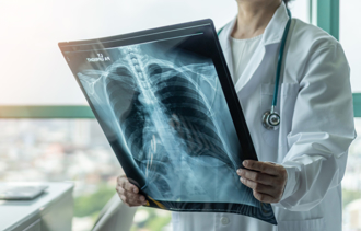 不抽菸、無家族史也中鏢 男走路喘竟是肺腺癌晚期