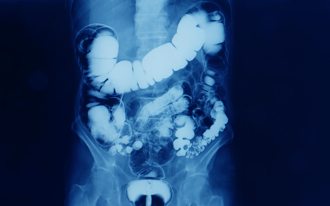 小心宿便清到肠道变色 1类泻药害黑肠症 医教判断