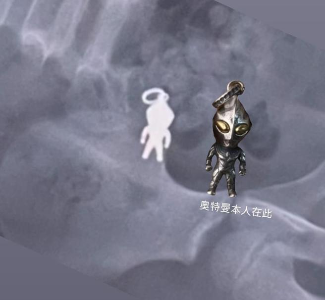 經X光檢查，吊飾約2.5×1.3公分，已隨腸道蠕動進入小腸。（民眾提供／吳佩蓉宜蘭傳真）