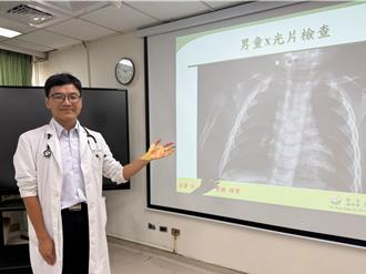 9月大男童確診肺炎鏈球菌 「疫苗打好打滿」住院10天痊癒