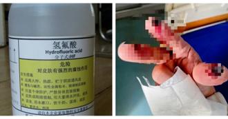 女誤散步誤踩「化骨水」慘死　浙江驚悚意外：氫氟酸滲蝕骨骼