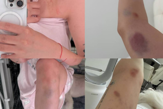 台女被打竟被罵「滾出韓國」 錄音曝光她嘆：想回歸正常生活