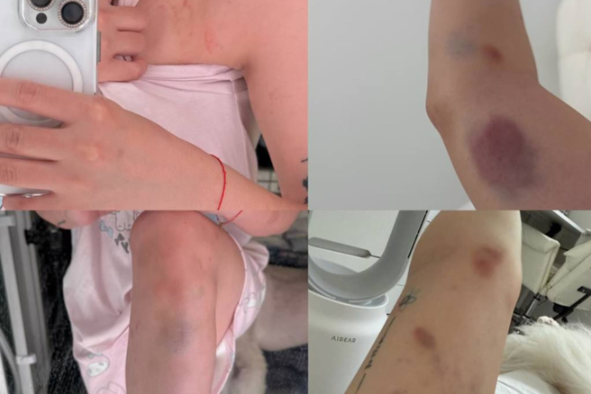 劉力穎曝光傷勢照。（圖／threads@liying0731）