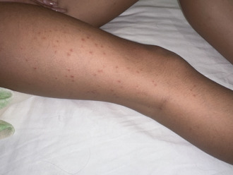 日女住日月潭飯店被床蝨咬「求償170萬」 業者回應了