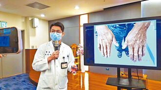 台東 乾癬誤當溼疹治 引發關節病變