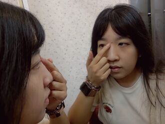 痘痘與遺傳有關 勿亂擠造成痘疤