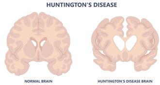 江飞宇Science》「悲剧遗传病」有望解决  亨廷顿舞蹈症首次治疗成功