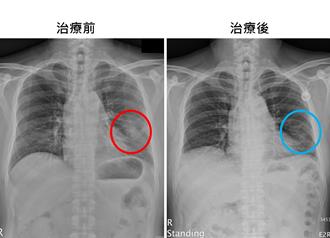 肺腺癌新曙光！健保給付免疫治療合併化療 延長存活期