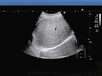高中生送急诊扫出「整块白亮肝」 医揭台湾人新国病