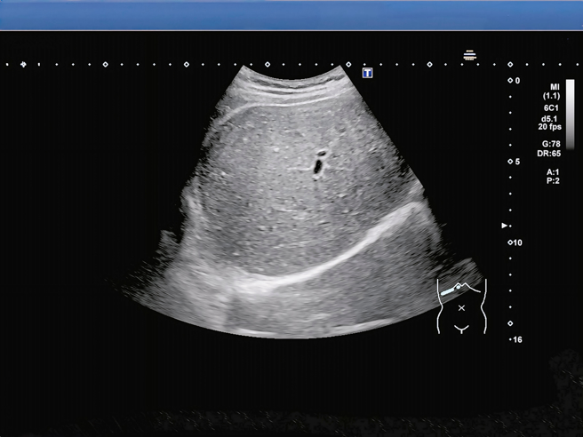 脂肪肝正悄悄成為台灣的新國病。（示意圖，Shutterstock／達志）