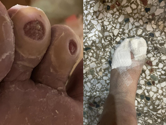 救災磨破腳趾險見骨 村長帶傷堅守花蓮災區：村民最重要