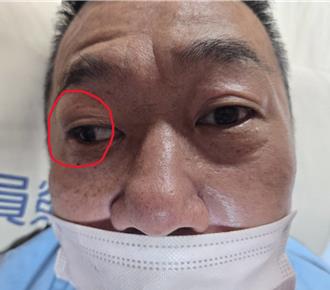 單眼模糊頭暈「以為中暑」！50多歲男竟是腦中風