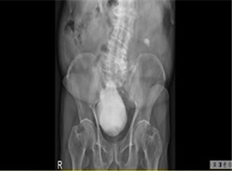 8旬男「尿不出来」竟是膀胱藏400克巨大结石