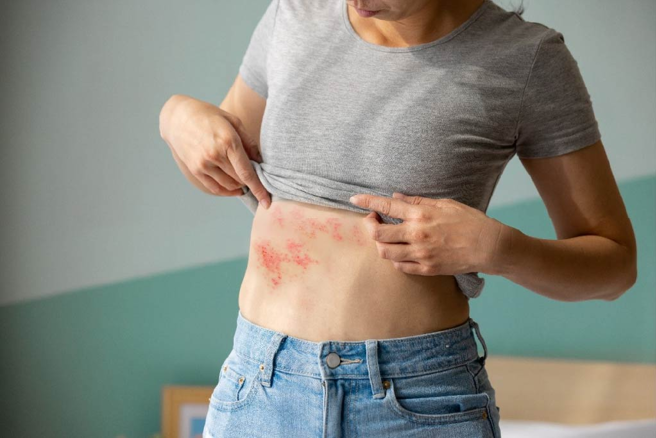 长期处于高压生活与作息不规律的状态，恐会引起带状疱疹。(图片来源： Shutterstock  )