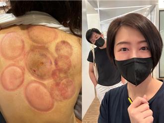 文汶创业太操「肌肉硬又痛」开刀 吴皓升疼妻上工前奔走