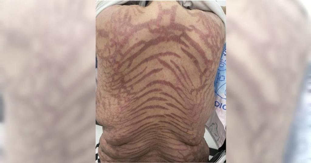 40歲女狂擦「萬能網紅神藥」全身冒紫紅斑紋 醫曝危險成分