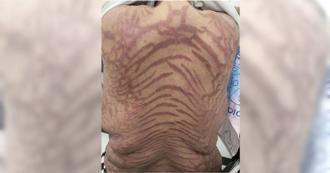 40歲女狂擦「萬能網紅神藥」全身冒紫紅斑紋  醫曝危險成分