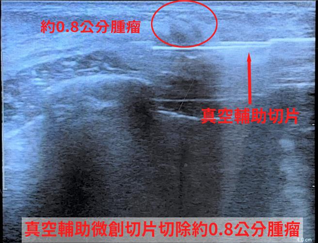 以真空辅助微创手术，切开的伤口藏在乳房侧面，或是在乳晕的边缘，伤口大概0.3到0.5公分。（中医大新竹附医提供／王惠慧新竹传真）