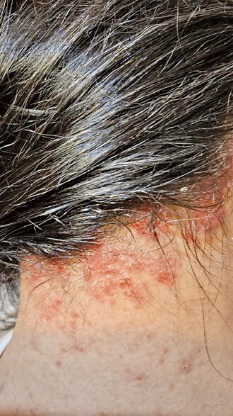 乾癬受三高共病影響 越看越多科