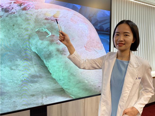 台中榮總過敏風濕免疫及一般內科醫師陳韻文解釋，罹患史帝文強生症候群的病人全身會出現紅疹與水泡，皮膚如同水蜜桃般脆弱。（陳淑娥攝）