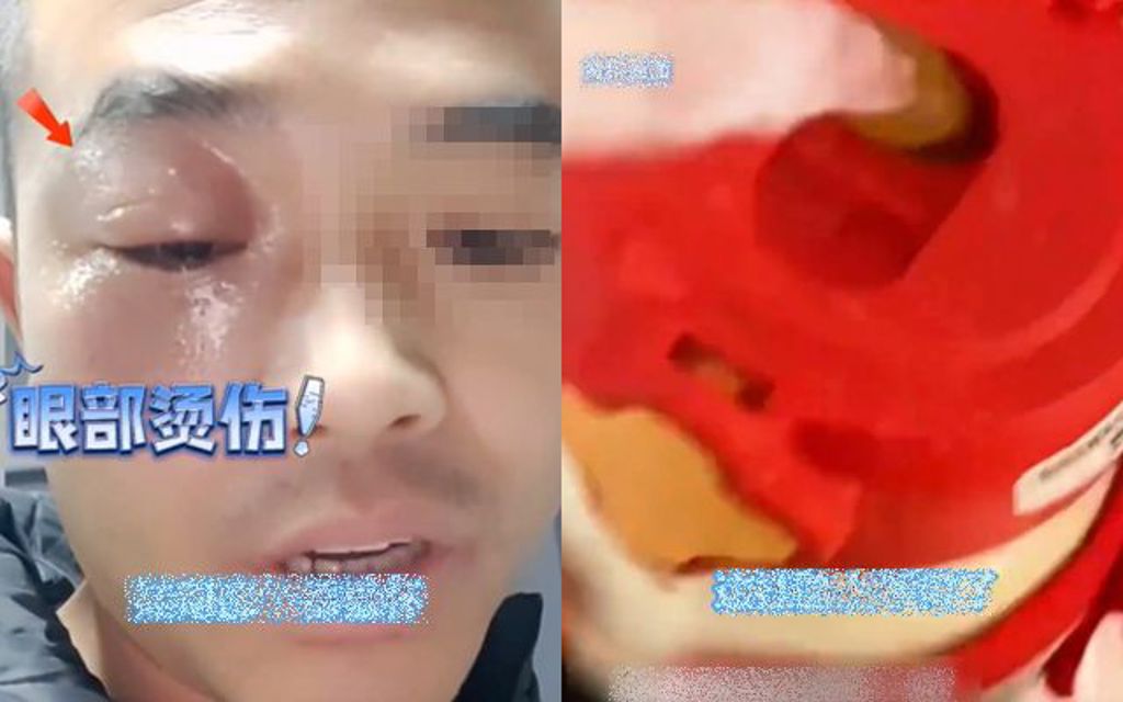 保溫瓶倒入「剛燒開熱水」 陸男遭噴濺燙傷：好險是大人