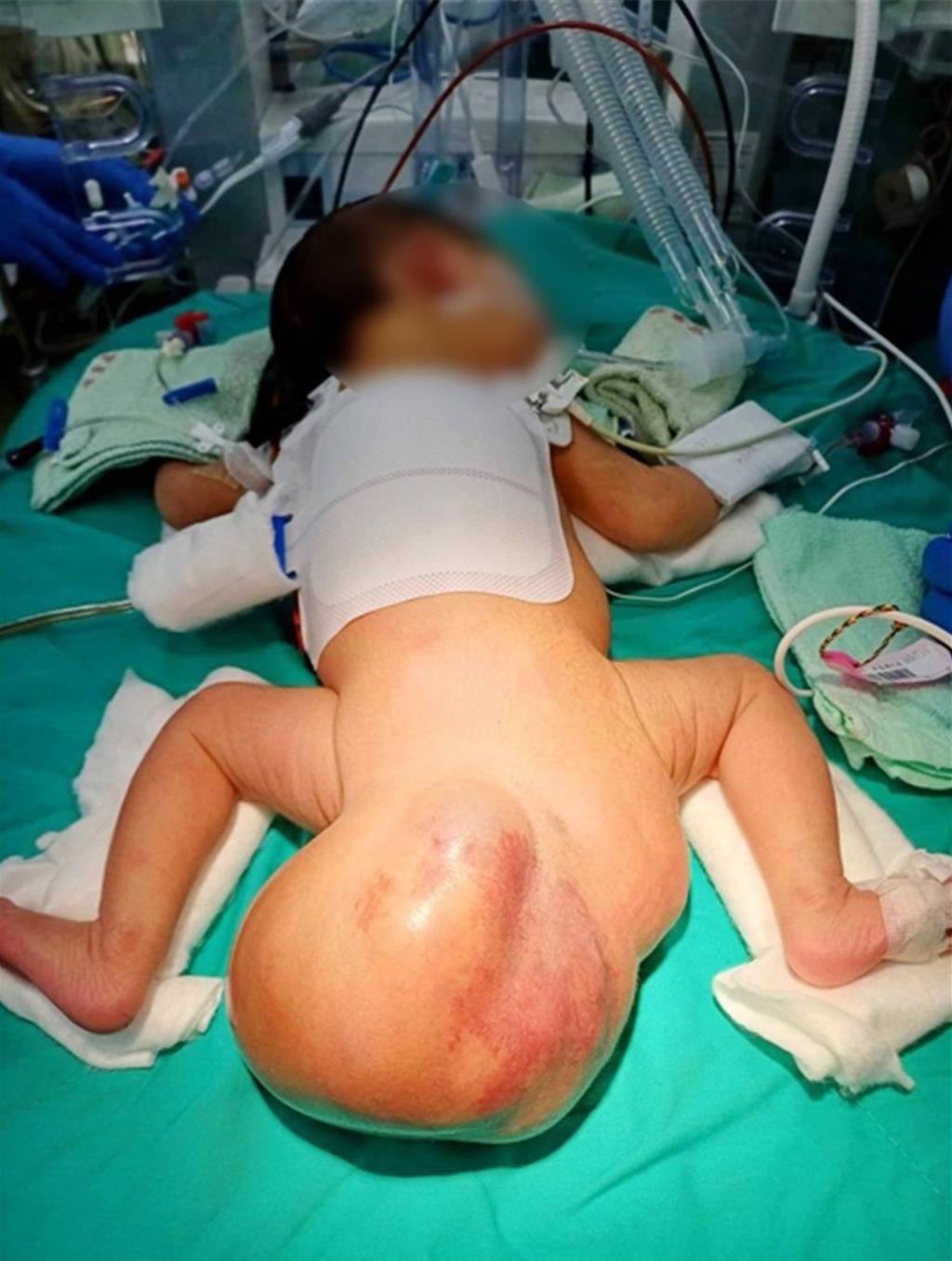 女嬰臀部「帶著大球」出生!醫護接力手術救回一線生機