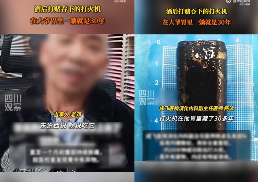 老翁腹痛就醫驚見「打火機？」　竟是30年前打賭吞下