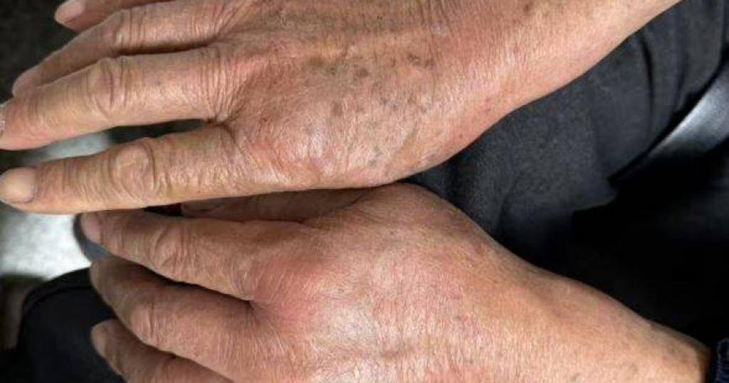 10幾秒爬滿全身！阿伯被火蟻圍攻險死　竟是「院子裡的寶貝」害的