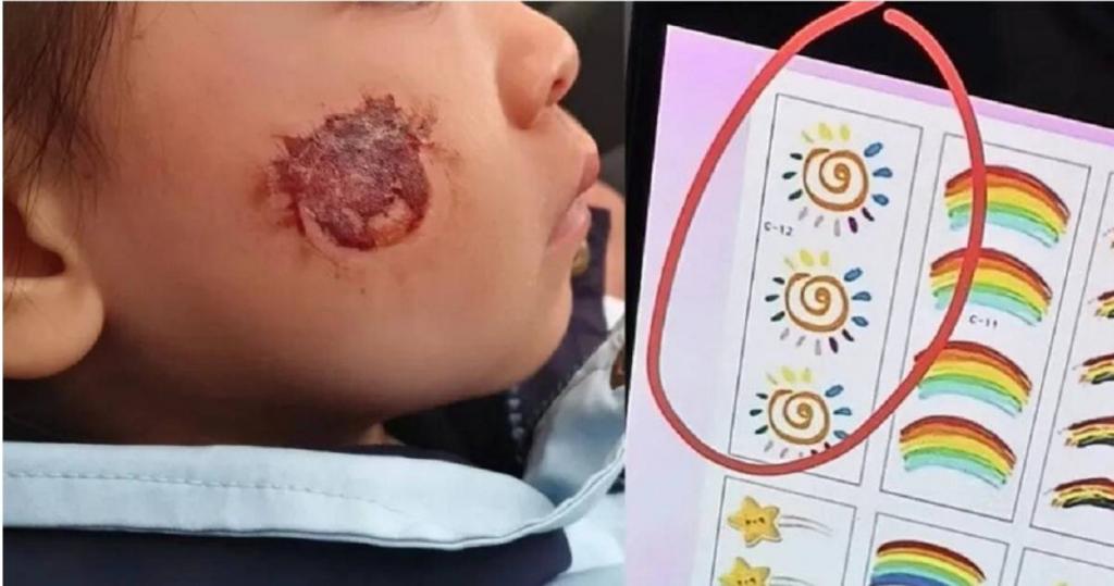 女童參加幼兒園活動  網購貼紙害她爛臉恐留疤！家長超崩潰