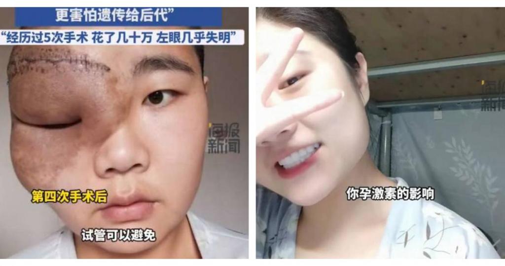 巨瘤壓迫左眼視力近全盲！28歲女憂遺傳  決定一輩子不婚