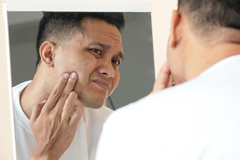 臉冒紅點未必是痘 醫曝3性病會偽裝 