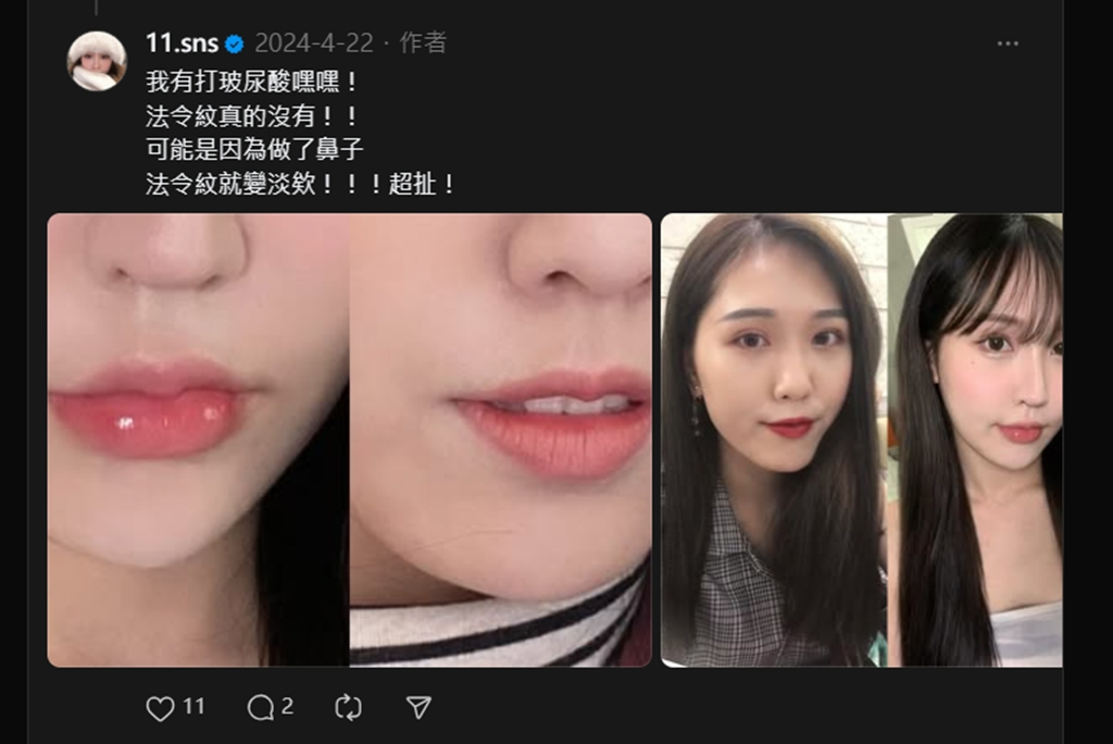 蕭伊分享打了玻尿酸。（圖／翻攝自 Threads）