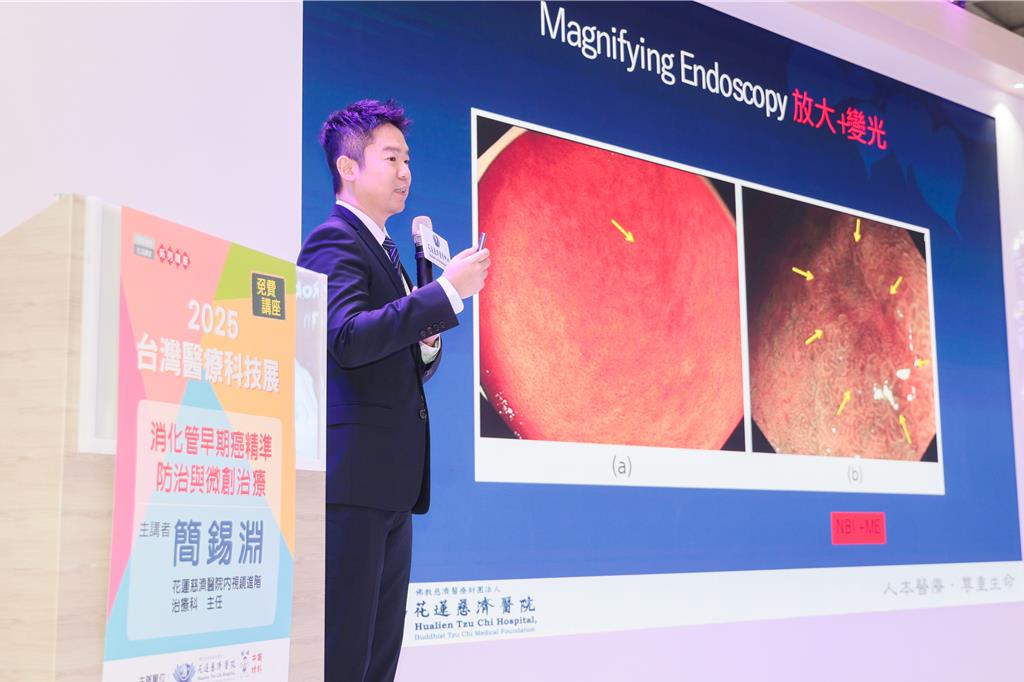 簡錫淵表示,消化管黏膜長出來的癌症越來越普遍,這些癌症都與「吃」有關係。(郭吉銓攝)