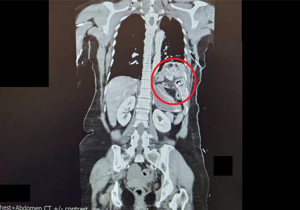 58歲婦車禍「胃腸擠入胸腔」 醫用腹腔鏡微創手術救命