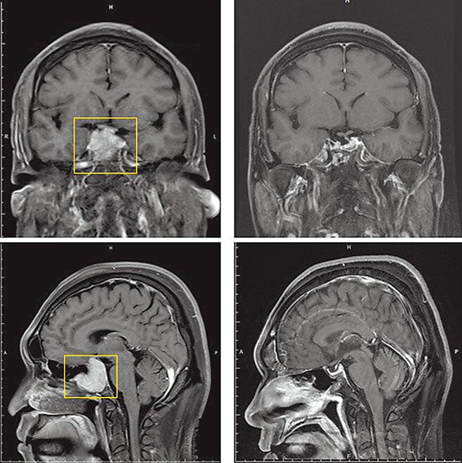 腦瘤壓迫變易怒免開顱新術除瘤