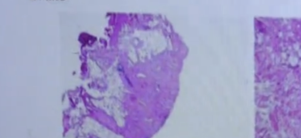 長年吸二手菸!陸13歲女童患胃癌晚期 腹腔腫瘤如撒豆子