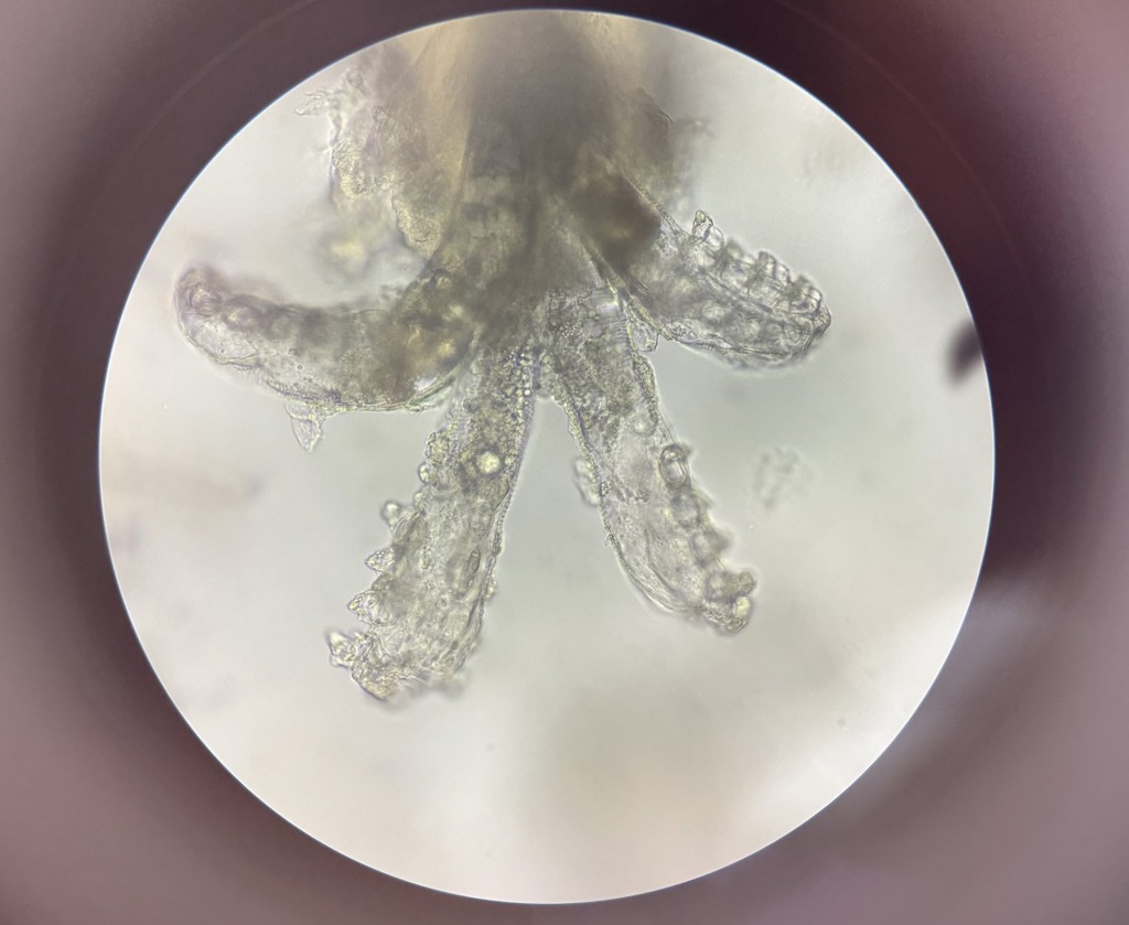 爛痘搞1年 女大生臉藏萬隻8腳蟲 醫:乳霜太油了