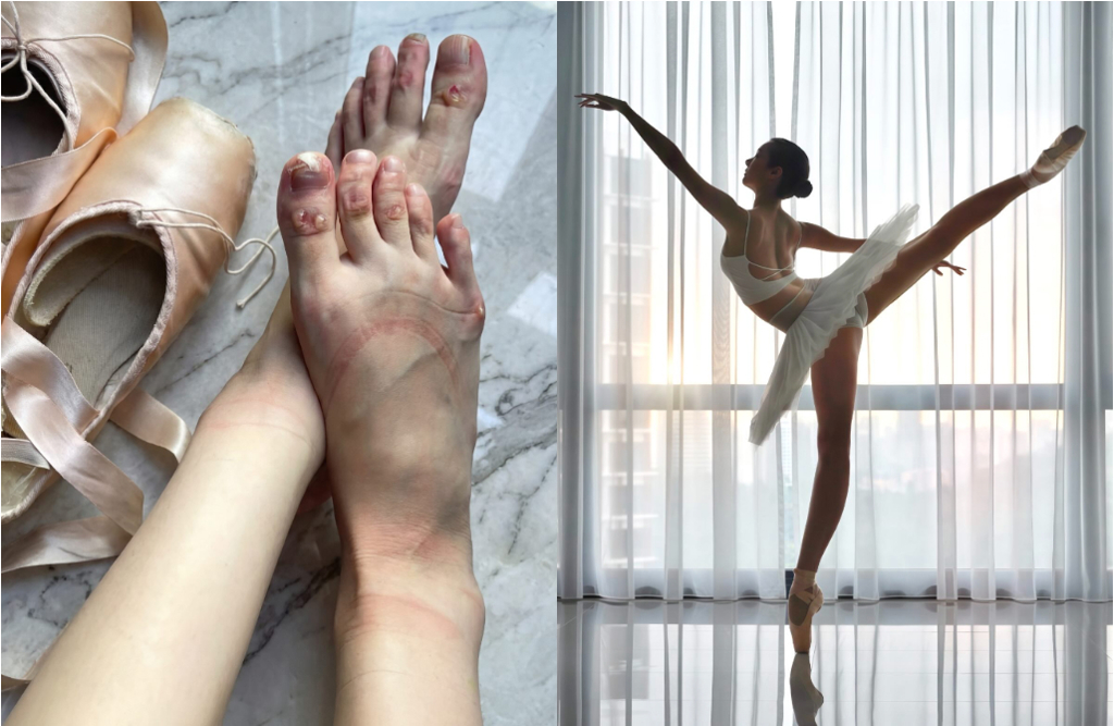 鋼琴女神苦練芭蕾 「紅腫水泡」傷勢照曝光惹心疼