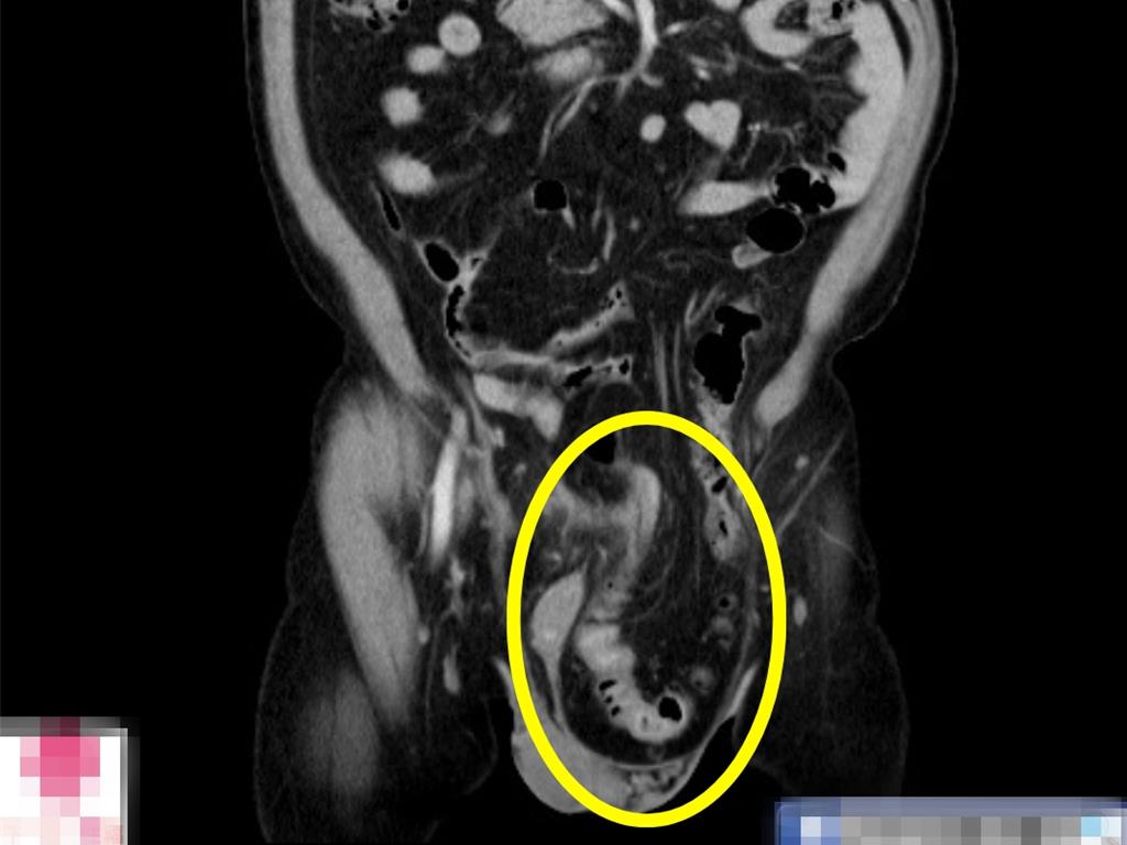 7旬翁雙側疝氣一碰就痛、難站立 達文西手術助重生 隔日可下床