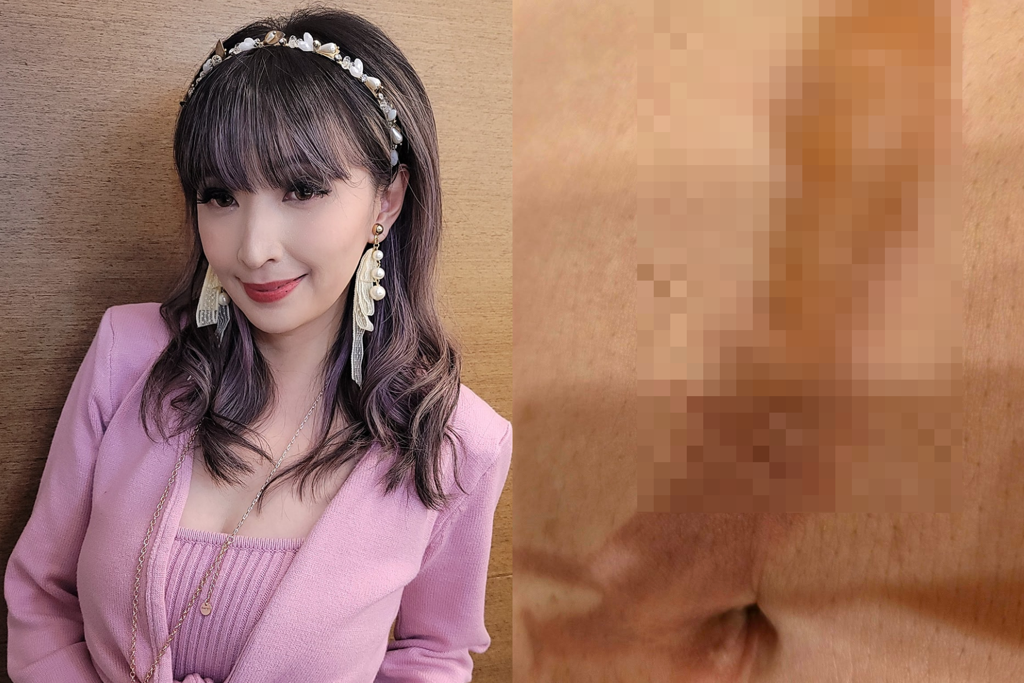 美女主播100度沸水失手潑身 二度燙傷超慘傷勢曝光